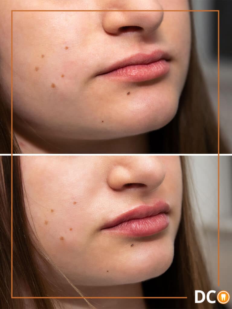 Povećanje usana prije i poslije